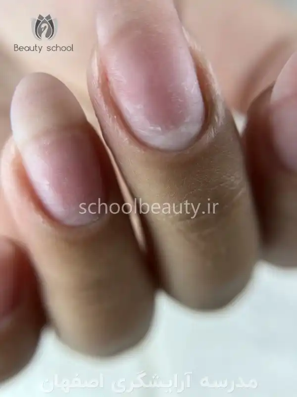 مراقبت از ناخن‌های کاشته شده، از پیشگیری تا درمان